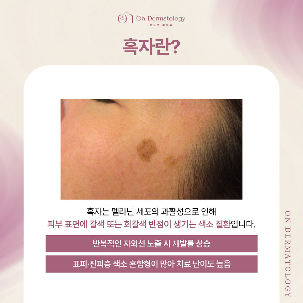 송파피부과 흑자 등 색소 피코레이저를 이용한 토닝 치료, 치료가 까다로운 이유? 관련 이미지 2