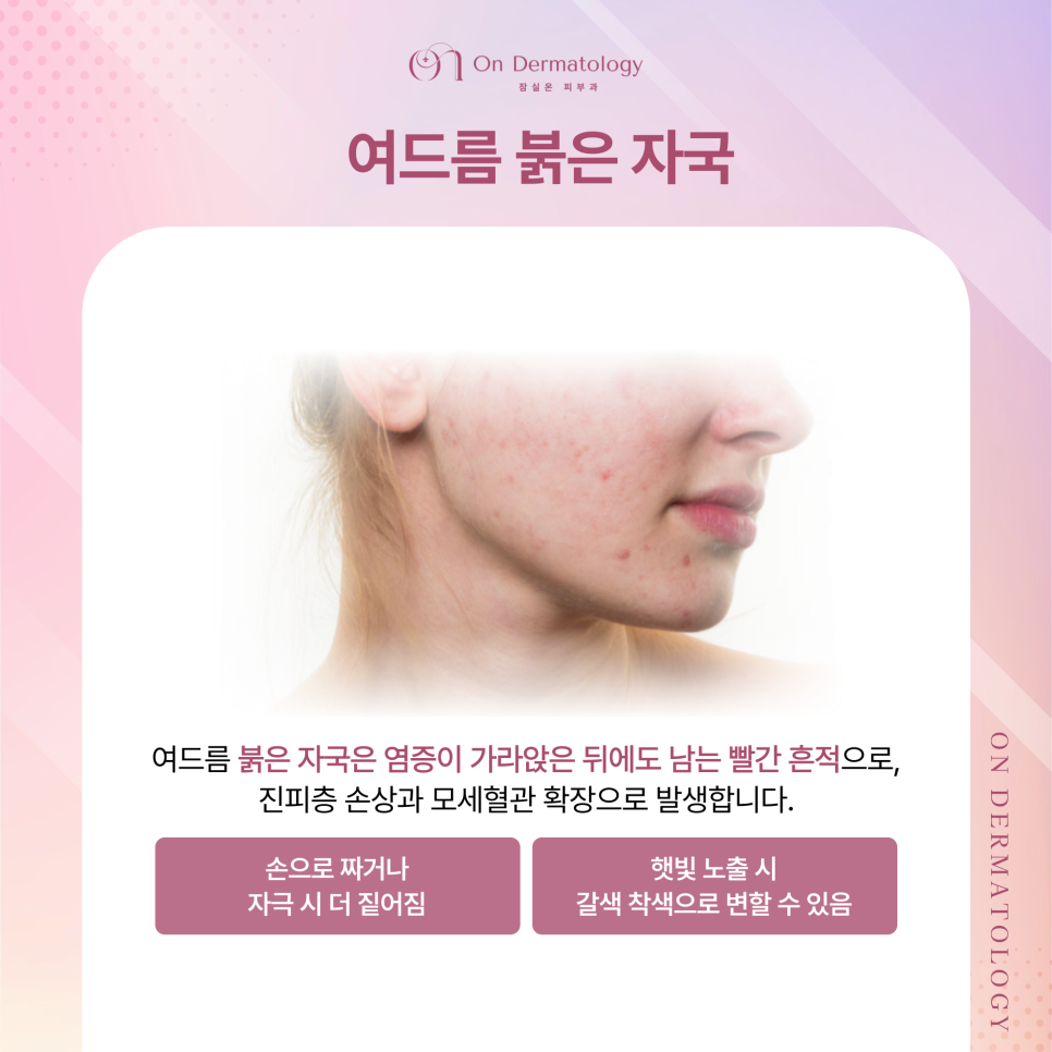 Shincheon-dong Dermatology: For Acne Red Marks, Vbeam Perfecta Treatment—What Are Its Advantages and Features? image 2