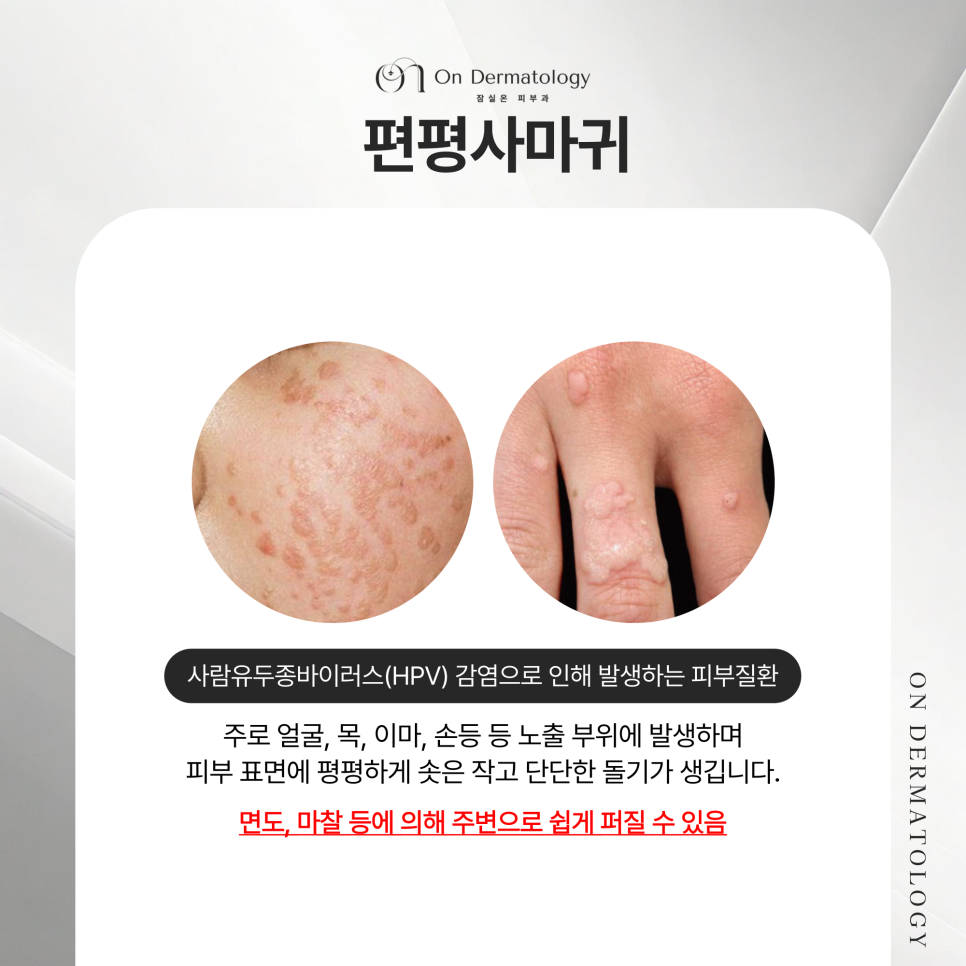 잠실 피부과 전문의 편평사마귀와 비립종 CO2레이저, 진행과정 및 치료 후 관리법 관련 이미지 2