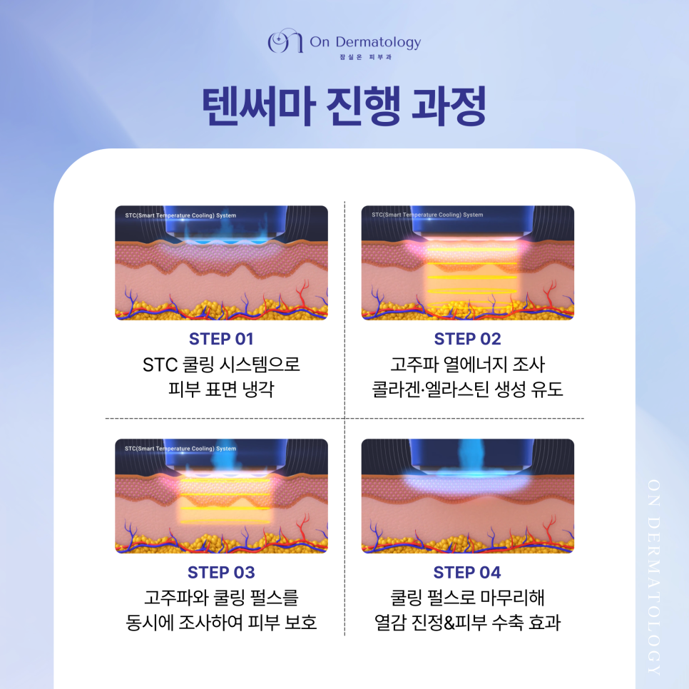 진피층 콜라겐 재생 리프팅 잠실 피부과 텐써마 효과 및 유지기간은? 관련 이미지 3