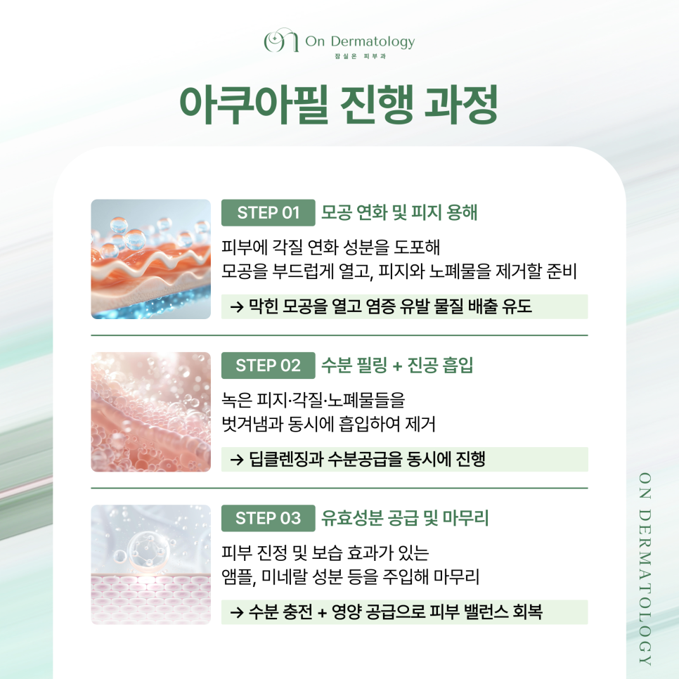 잠실역 피부과 전문의 여드름 압출과 스케일링, 그리고 여드름 원인치료까지 자세히 관련 이미지 5