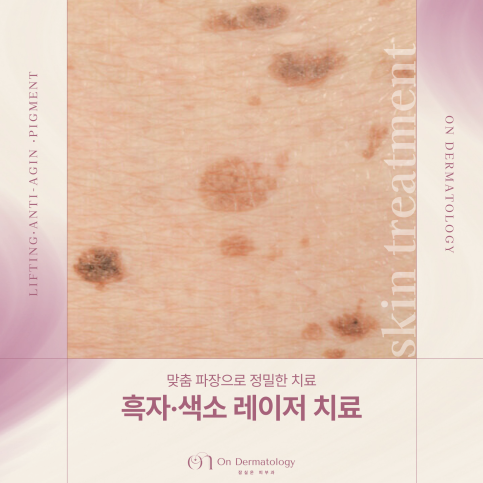 송파피부과 흑자 등 색소 피코레이저를 이용한 토닝 치료, 치료가 까다로운 이유? 관련 이미지 1