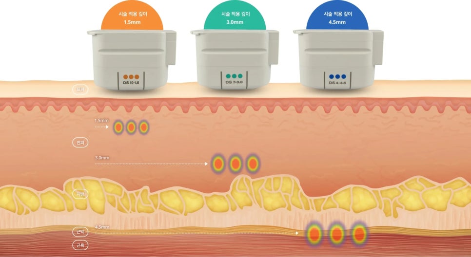 What Is Ultherapy PRIME? Which Faces Are Suitable for Ultherapy? image 2