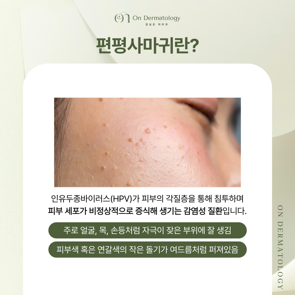 잠실역 피부과 전문의 편평사마귀 CO2레이저 제거 시 장점 및 방치하면 안되는 이유? 관련 이미지 2