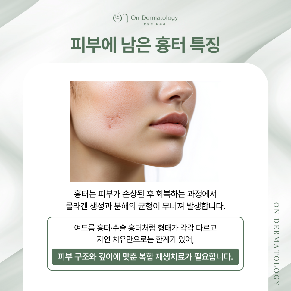 잠실피부과 피코MLA 및 서브시전 포함 흉터 복합 재생치료, 여러 치료 병행하는 이유? 관련 이미지 2