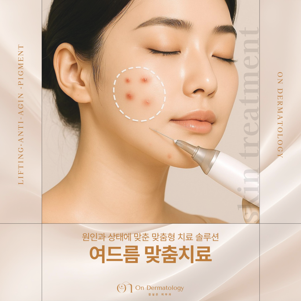 Songpa Dermatology Acne Customized Treatment, from Potenza Sebaceous Gland Destruction to Vbeam Perfecta image 1