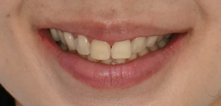 치아미백 시술,  시간과 가격 한계점까지 알려드립니다. 관련 이미지 2