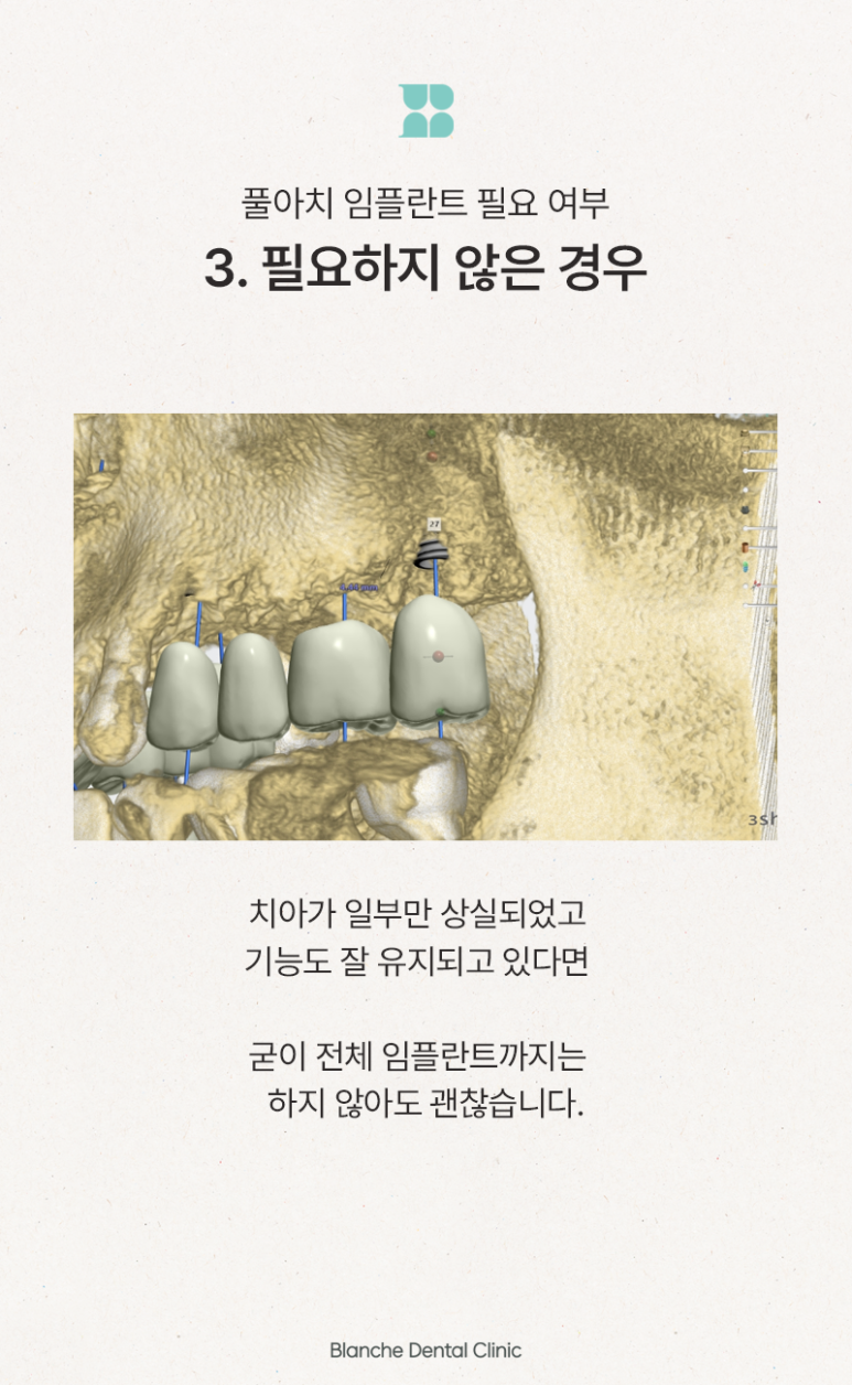 풀아치 임플란트 대상, 치료 시기와 기준을 알려드립니다 관련 이미지 7