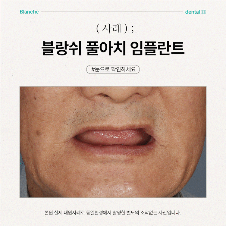 풀아치 임플란트 비용, 방법, 효과 모두 정리했습니다. 관련 이미지 8