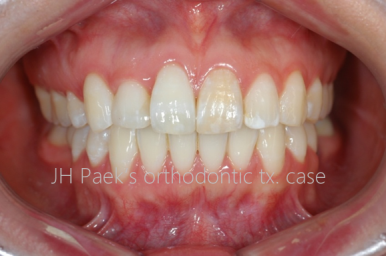 덧니 교정 비용? 관련 이미지 4