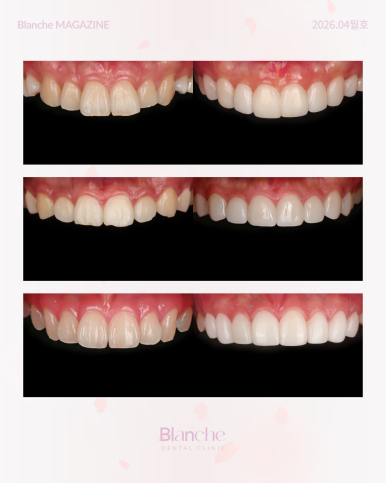 무삭제 라미네이트? 누구나 할 수 없는 진짜 이유 관련 이미지 12