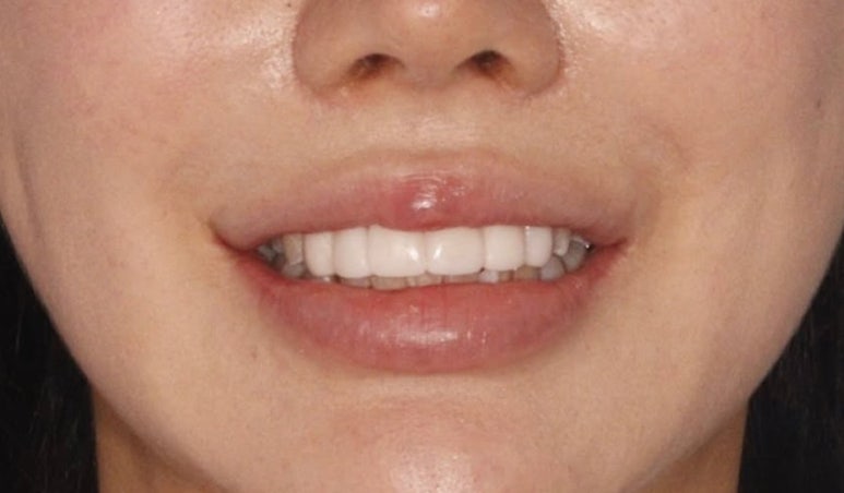 무삭제 라미네이트 가격 비교? 이 글로 정리해드립니다. 관련 이미지 12