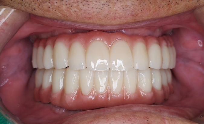 발치 없이 가능할까? 앞니 부분교정 전 반드시 체크해야 할 진단 포인트 관련 이미지 9