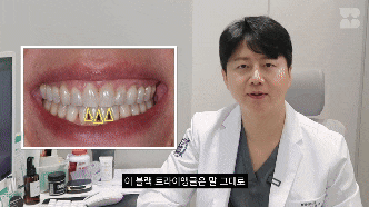 앞니 사이에 생긴 틈을 해결하는 방법 (블랙 트라이 앵글) 관련 이미지 3