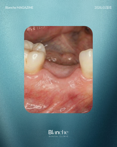 "임플란트 뼈이식, 무조건 해야 하나요?" 과잉진료 피하는 법 관련 이미지 12