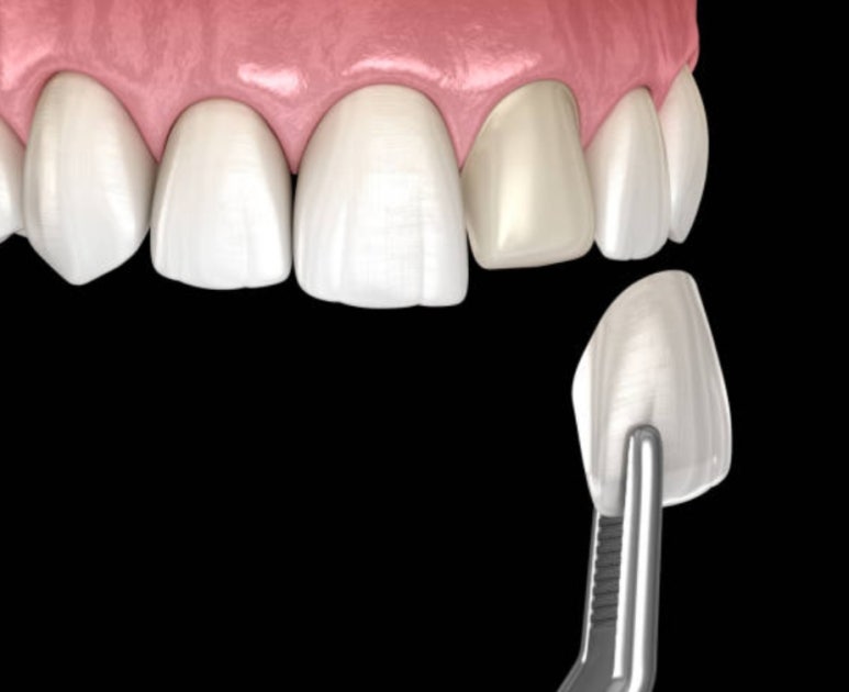 무삭제라미네이트 비용에 관한 숨겨진 진실, 모두 공개합니다. 관련 이미지 4