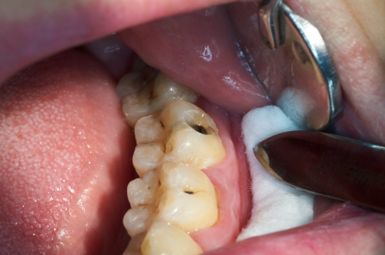 Can a Molar Cavity Be Treated with an Inlay, or Does It Need a Crown? — How Chewing Forces Determine the Choice image 4