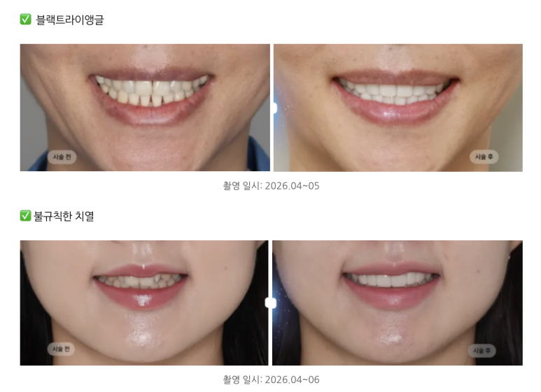 No-Prep Veneers vs. Minimal-Prep Veneers in Gangnam: How to Choose the Right Option for Your Teeth image 4