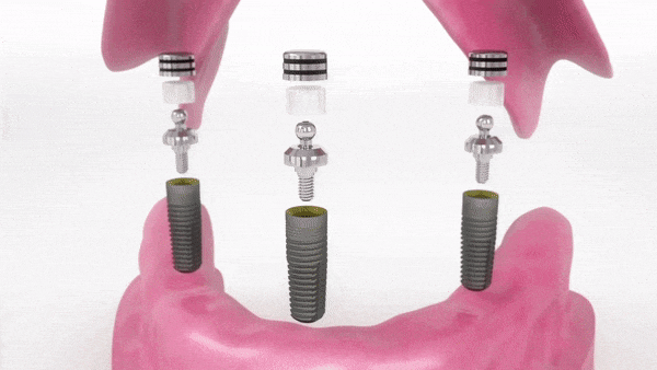 풀아치 임플란트 비용, 방법, 효과 모두 정리했습니다. 관련 이미지 4