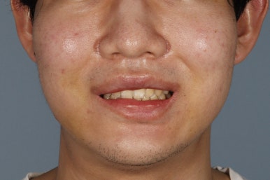 무삭제 라미네이트 비용, 이것만은 꼭 확인했어야 했어요 관련 이미지 18