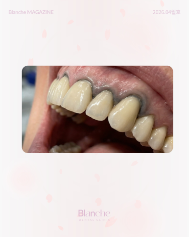 잇몸이 까맣게 변했어요! 원인별 맞춤 해결법 관련 이미지 8