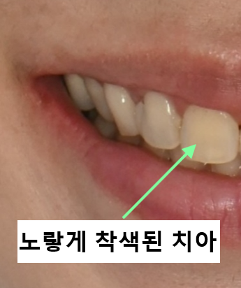 자가치아미백? 이것만으로는 어려운 이유 관련 이미지 1