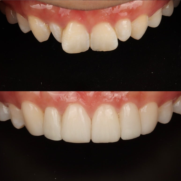 치아 무삭제 라미네이트, 관련 이미지 8