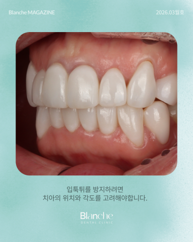 라미네이트 후 관련 이미지 7