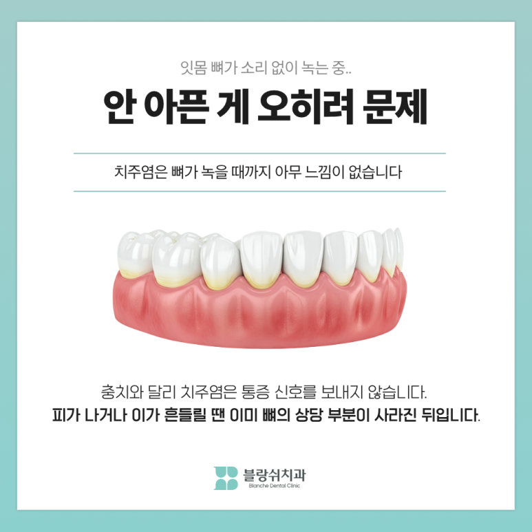 치주염 치료, 지금이랑 1년 뒤랑 뭐가 다를까요 관련 이미지 2