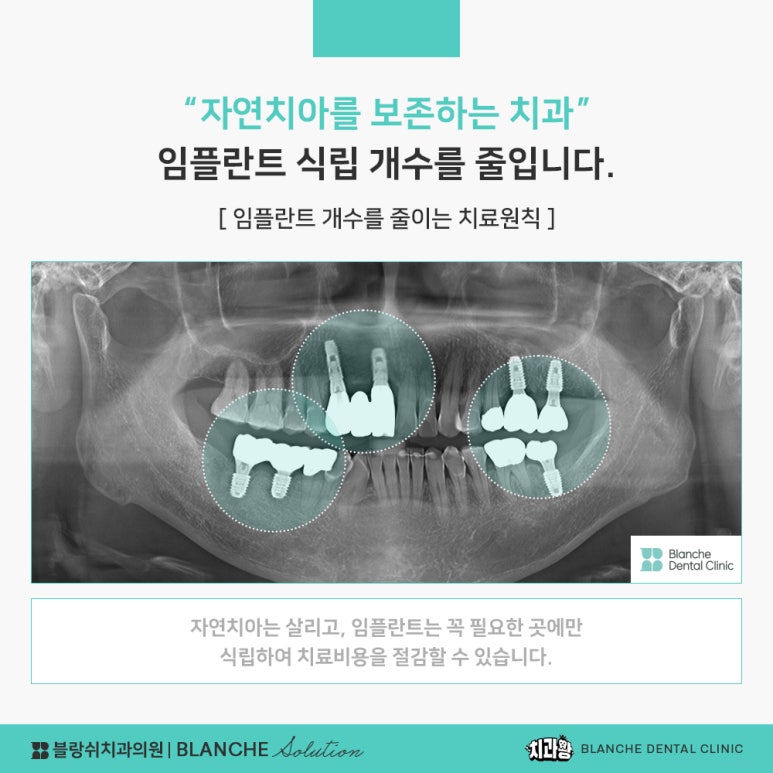 수면임플란트센터, 프리미엄 임플란트 진료는 블랑쉬치과(Blanche Dental Clinic) 관련 이미지 28