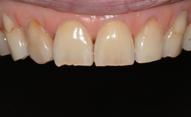 커피 치아착색? 누런 치아가 신경 쓰인다면 지금 확인하세요. 관련 이미지 3