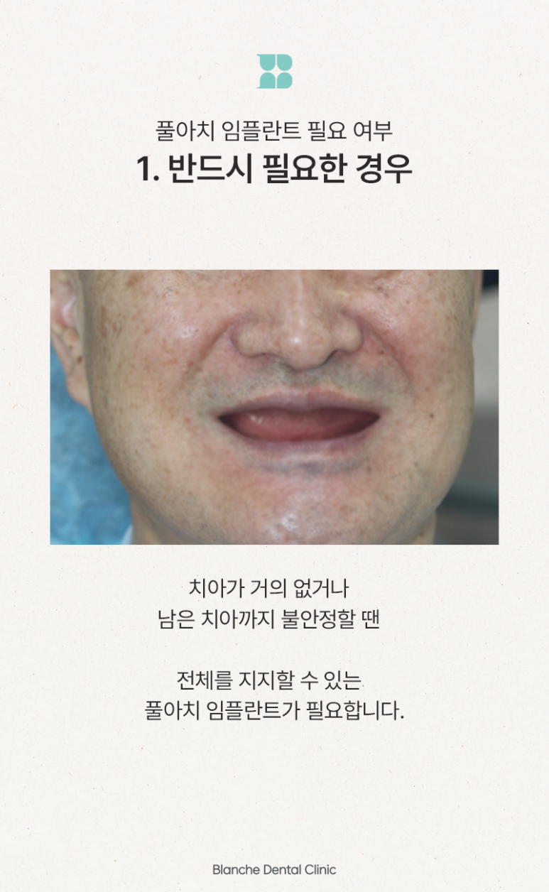 풀아치 임플란트 대상, 치료 시기와 기준을 알려드립니다 관련 이미지 5