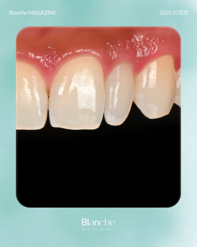 유독 작은 옆니(왜소치), 깎지 않고 예뻐질 수 있을까? 관련 이미지 3