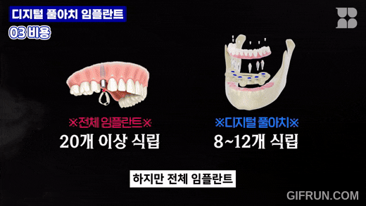 디지털 풀아치 임플란트 비용, 그전에 꼭 따져봐야 할 게 있습니다 관련 이미지 11