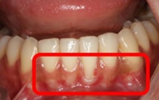 Side Effects of No-Prep Laminates, image 5