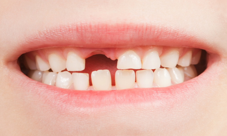 Composite Resin vs. Inlay: Differences in Price, Lifespan & Insurance Coverage | A Dentist’s Guide to Choosing Cavity Treatment image 5