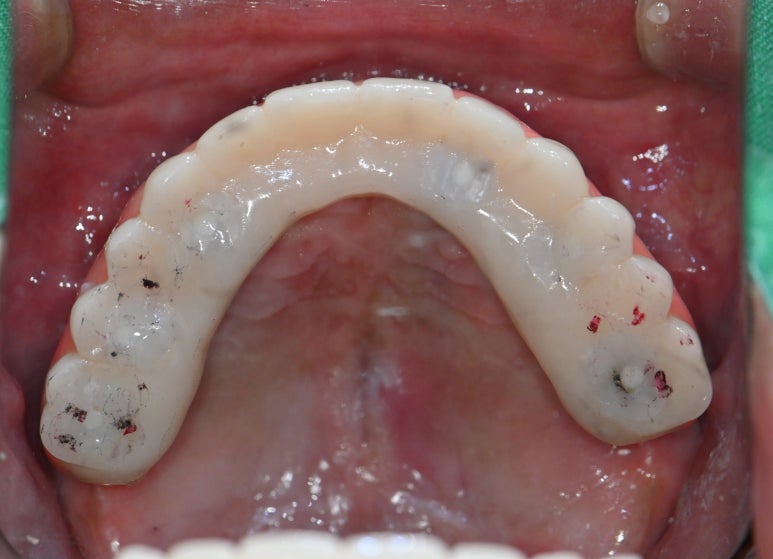 강남 풀아치 임플란트 치과, 4개로 틀니를 대체한다? 관련 이미지 12