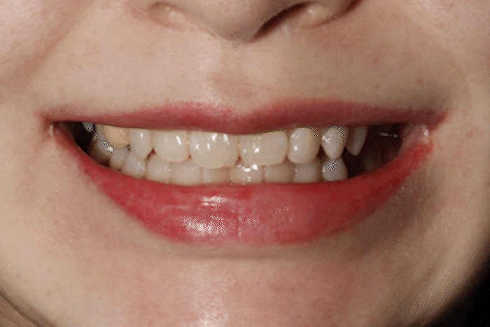 무삭제 라미네이트 부작용, 모르고 진행하면 손해보는 이유 관련 이미지 1