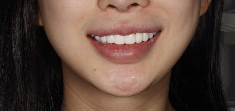 무삭제 라미네이트 추천, 어떤 케이스에 적합할까요? 관련 이미지 4