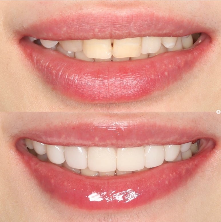 치아 무삭제 라미네이트, 관련 이미지 1