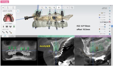 강남 풀아치 임플란트 치과, 4개로 틀니를 대체한다? 관련 이미지 10