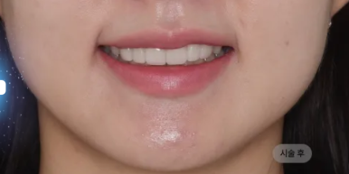 5 Criteria to Review Before Deciding on Minimal-Preparation Veneers image 9