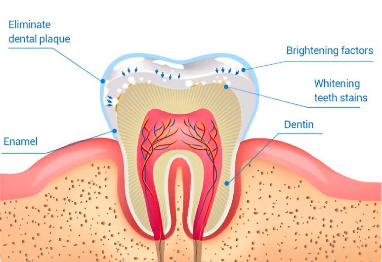 치아미백 시술? 블랑쉬? 어떤 것이 좋을지 고민된다면 관련 이미지 4