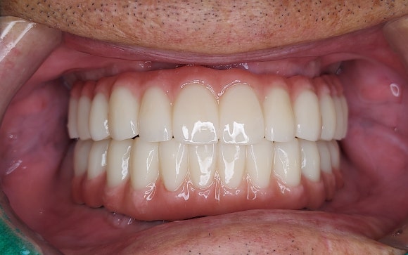 어금니 임플란트 뼈이식 통증 비용 총정리 관련 이미지 10