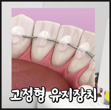 압구정치과 치아교정이 고민이라면 필독 관련 이미지 14