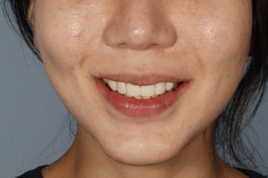 무삭제 라미네이트 비용, 이것만은 꼭 확인했어야 했어요 관련 이미지 16