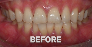 치아미백 시술,  시간과 가격 한계점까지 알려드립니다. 관련 이미지 11