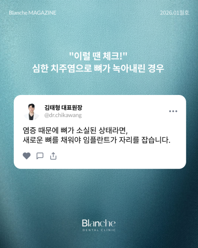 "임플란트 뼈이식, 무조건 해야 하나요?" 과잉진료 피하는 법 관련 이미지 13