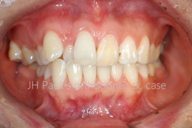 뻐드렁니 교정 2년 고생하고 후회하는 사람 vs 6개월 만에 인생 미소 찾은 사람 관련 이미지 4