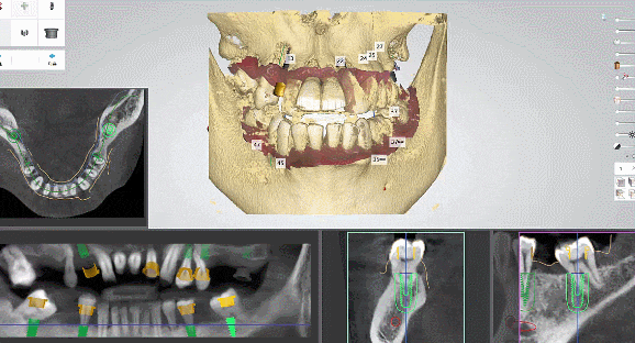 풀아치 임플란트 비용, 방법, 효과 모두 정리했습니다. 관련 이미지 7